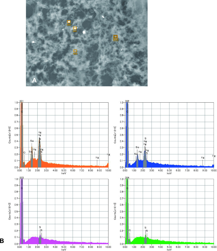 Mercury and Selenium Localization in the Cerebrum, Cerebellum, Liver, and Kidney of a Minamata Disease Case.