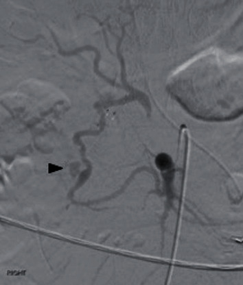 Coil Embolization of Arc of Buhler Aneurysm Rupture.