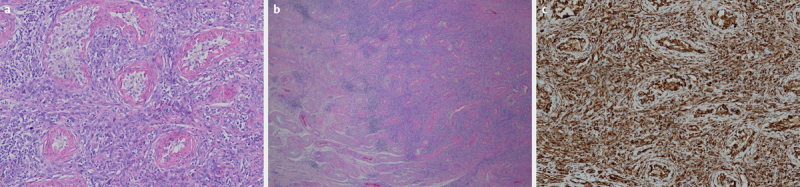 Testicular Metastatic Sarcomatoid Carcinoma of Unknown Primary: A Case Report.