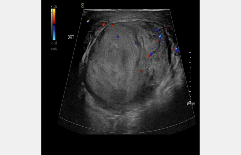 Testicular Metastatic Sarcomatoid Carcinoma of Unknown Primary: A Case Report.