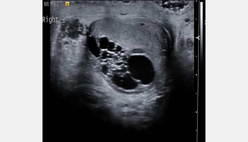 Testicular Metastatic Sarcomatoid Carcinoma of Unknown Primary: A Case Report.