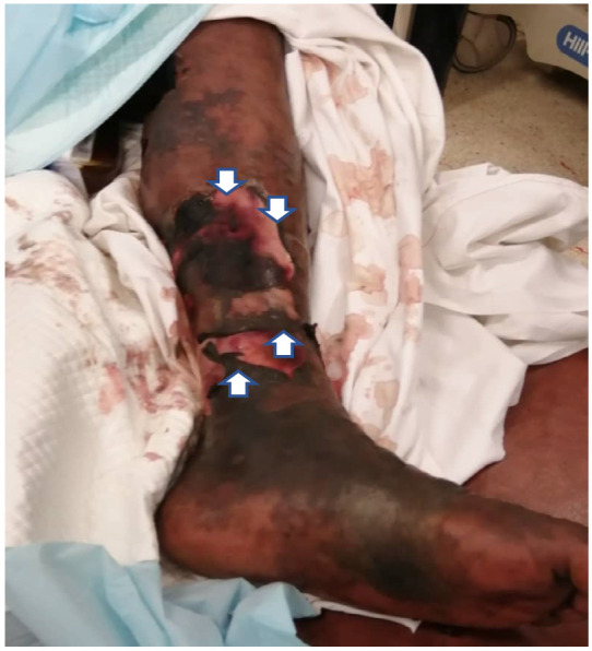 Warfarin-induced skin necrosis: a rare condition.