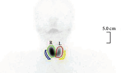 The Unusual Late-Onset Graves' Disease following Hashimoto's Related Hypothyroidism: A Case Report and Literature Review.