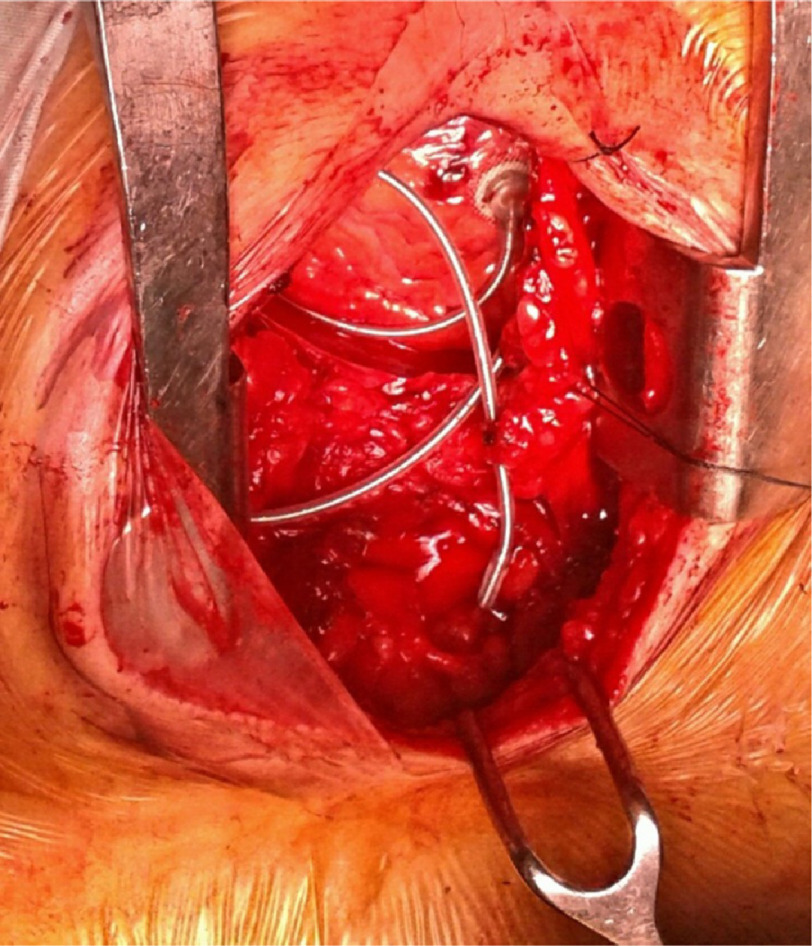 Journey to the center of the heart: Bilateral absent superior vena cava with heart block.