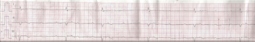 Journey to the center of the heart: Bilateral absent superior vena cava with heart block.