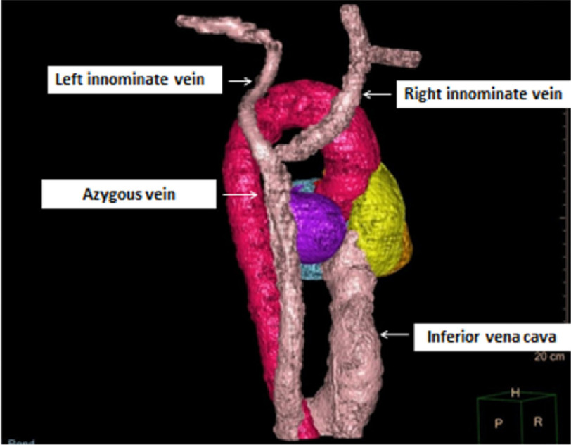 Journey to the center of the heart: Bilateral absent superior vena cava with heart block.