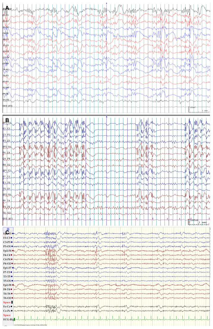 Juvenile Myoclonic Epilepsy: Myoclonic Status Epilepticus without Coma - Report of Three Cases.