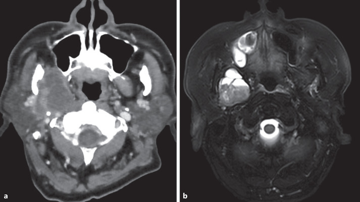 Intraductal Carcinoma of the Parotid Gland Presenting as Parapharyngeal Mass.