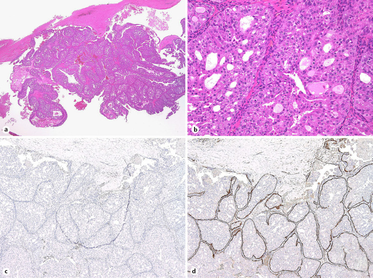 Intraductal Carcinoma of the Parotid Gland Presenting as Parapharyngeal Mass.