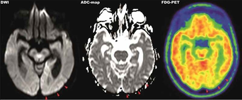 An enigmatic case of cortical anopsia: Antemortem diagnosis of a 14-3-3 negative Heidenhain-variant MM1-sCJD.