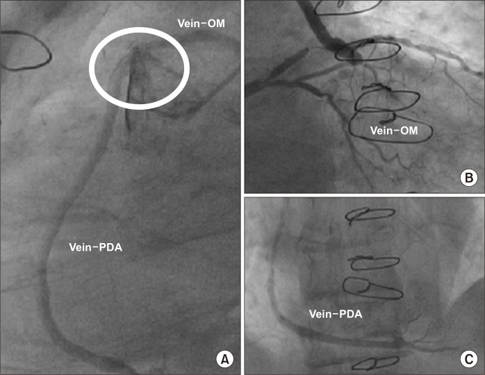 First Results of the Single Heartstring Aortotomy for Multiple Off-Pump Vein Grafts: A Case Series.