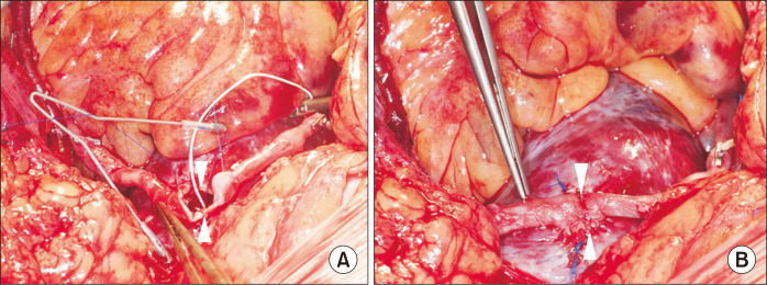 First Results of the Single Heartstring Aortotomy for Multiple Off-Pump Vein Grafts: A Case Series.