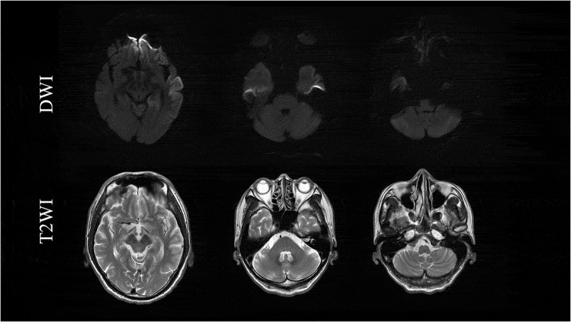 A patient with spastic paralysis finally diagnosed as V180I genetic Creutzfeldt-Jakob disease 9 years after onset.