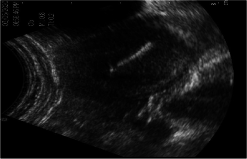 Removal of a missing intrauterine contraceptive device after location through an ultrasound: a case report within a rural setting and review of literature.