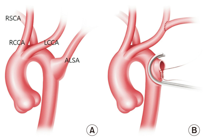 Surgical Outcomes of Kommerell Diverticulum.