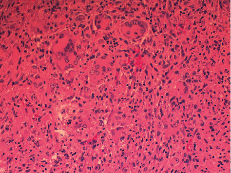 Multiple Xanthogranulomas in an Adult Patient with Myelodysplastic Syndrome.