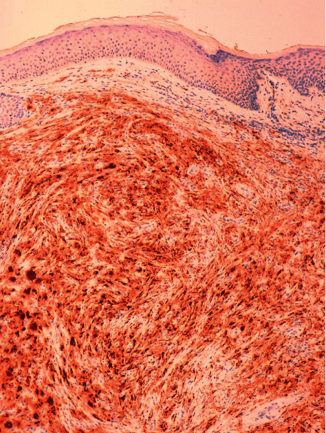 Multiple Xanthogranulomas in an Adult Patient with Myelodysplastic Syndrome.