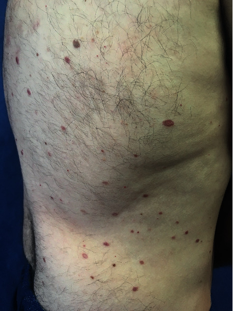 Multiple Xanthogranulomas in an Adult Patient with Myelodysplastic Syndrome.