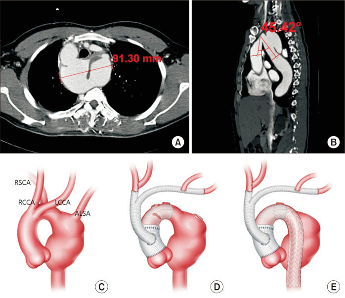 Surgical Outcomes of Kommerell Diverticulum.