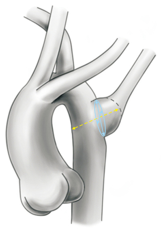 Surgical Outcomes of Kommerell Diverticulum.