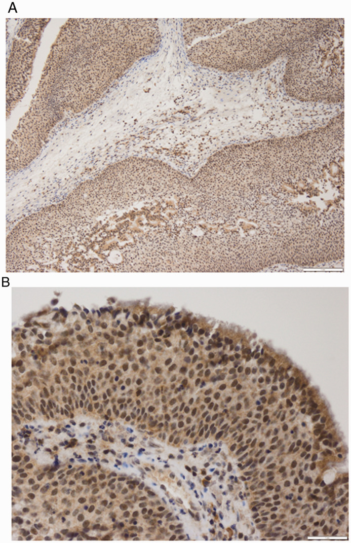 COX-2 Overexpression in Schneiderian Papillomas.