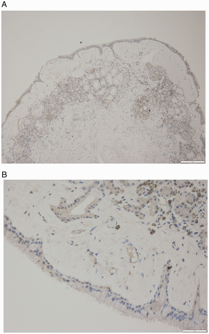 COX-2 Overexpression in Schneiderian Papillomas.