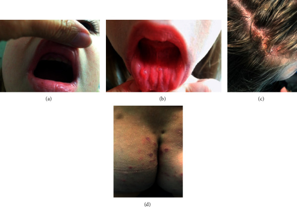 On Two Cases with Autosomal Dominant Hyper IgE Syndrome: Importance of Immunological Parameters for Clinical Course and Follow-Up.