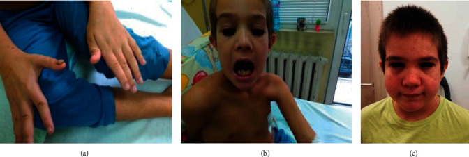 On Two Cases with Autosomal Dominant Hyper IgE Syndrome: Importance of Immunological Parameters for Clinical Course and Follow-Up.