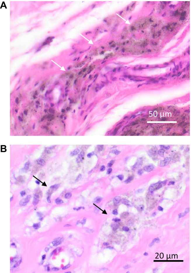 Bacterial Biofilm Components Induce an Enhanced Inflammatory Response Against Metal Wear Particles.