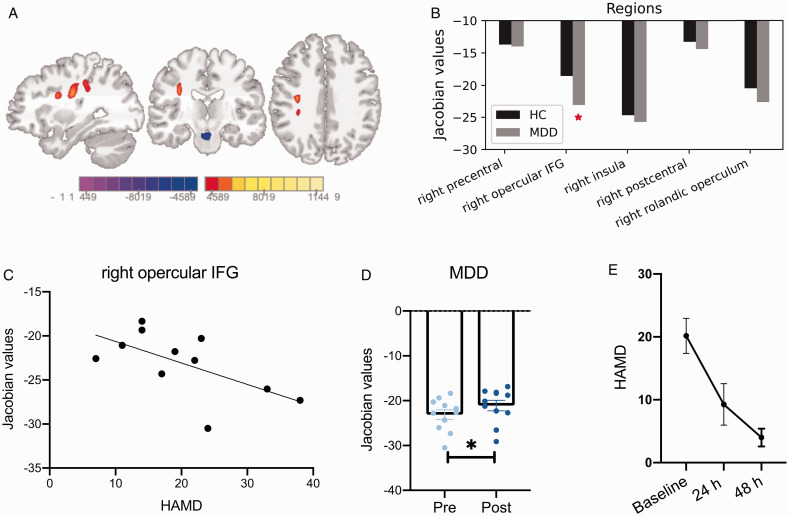 Ketamine Normalizes the Structural Alterations of Inferior Frontal Gyrus in Depression.