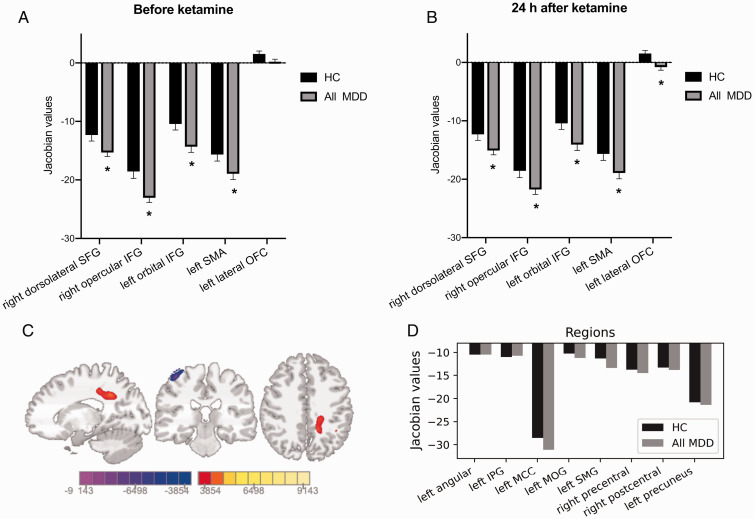 Ketamine Normalizes the Structural Alterations of Inferior Frontal Gyrus in Depression.