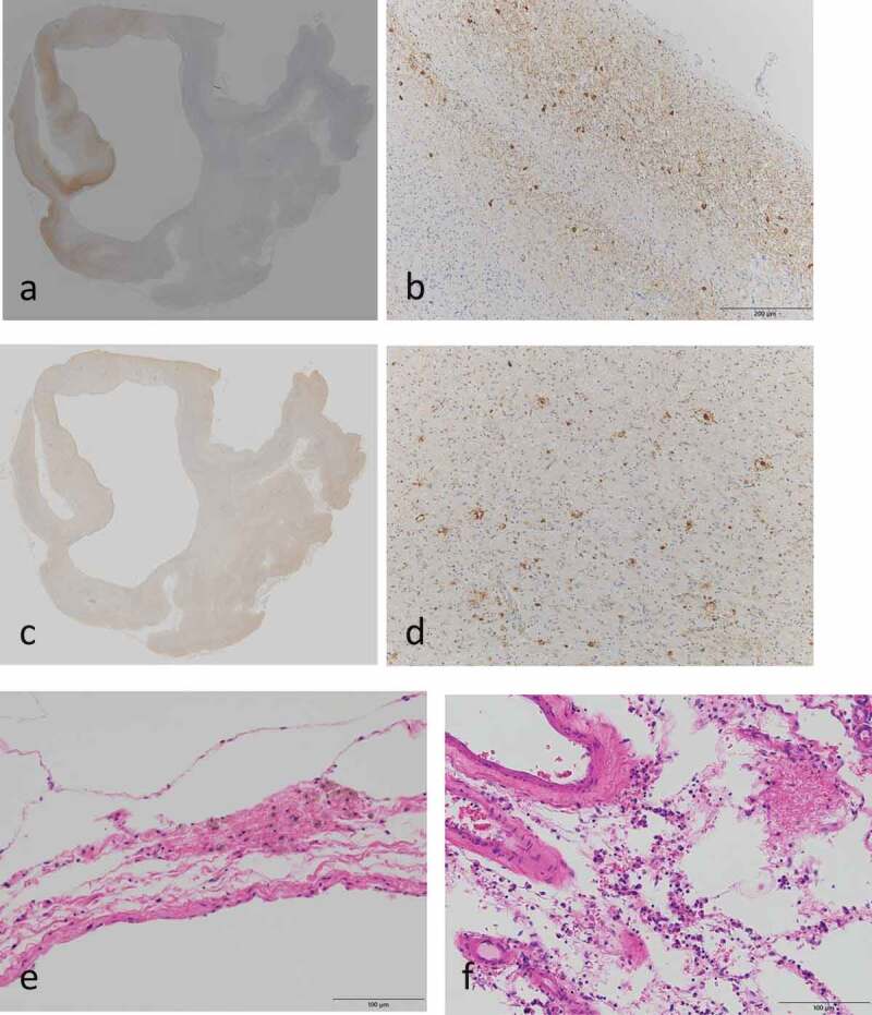 Clinicopathological findings of a long-term survivor of V180I genetic Creutzfeldt-Jakob disease.