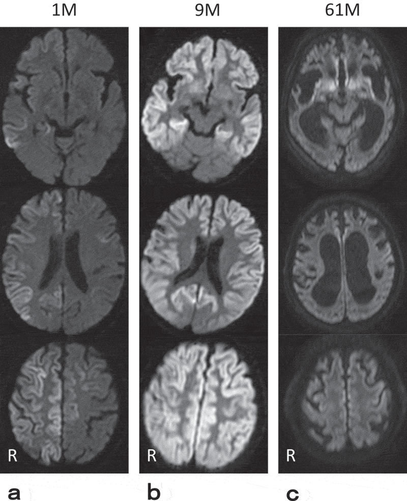 Clinicopathological findings of a long-term survivor of V180I genetic Creutzfeldt-Jakob disease.