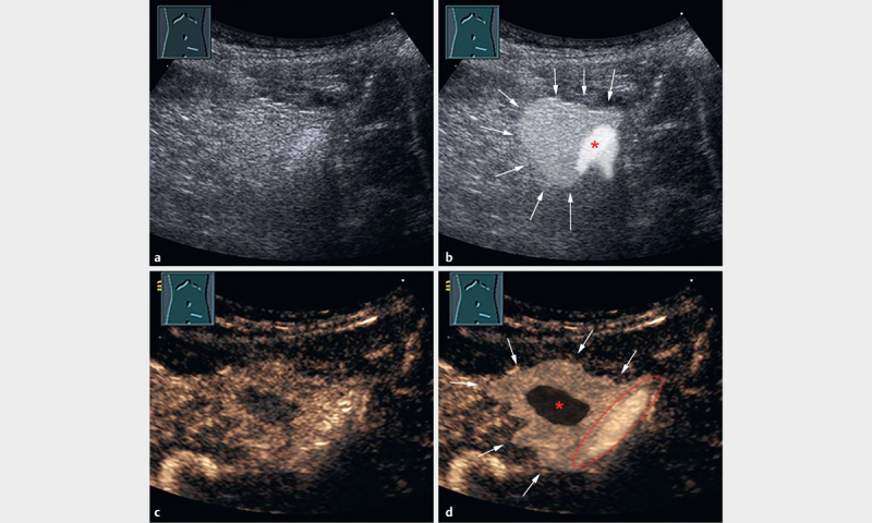 Clinical Awareness and Acceptance of Sonographically Diagnosed Epiploic Appendagitis (EA): A Retrospective Analysis of EA in a Single Tertiary Academic Referral Center.