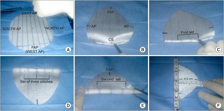 The Impact of the "Slim-Mesh" Technique on Operation Time and Short/Midterm Outcomes in 67 Overweight, Obese and Superobese Patients from a 10-year Follow-up Study.