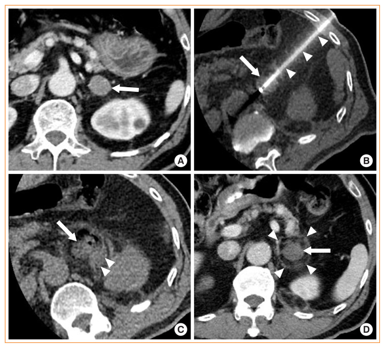 Percutaneous Adrenal Radiofrequency Ablation: A Short Review for Endocrinologists.