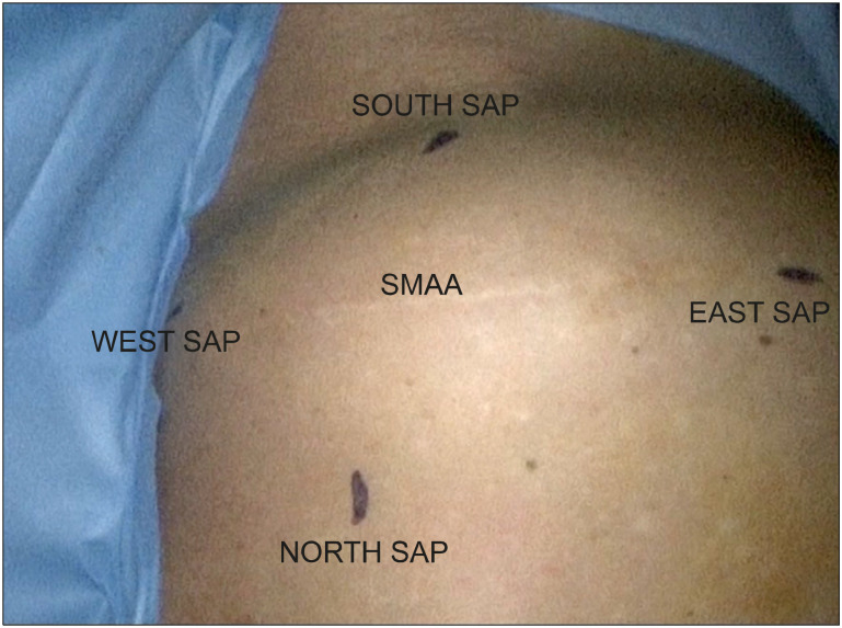 The Impact of the "Slim-Mesh" Technique on Operation Time and Short/Midterm Outcomes in 67 Overweight, Obese and Superobese Patients from a 10-year Follow-up Study.