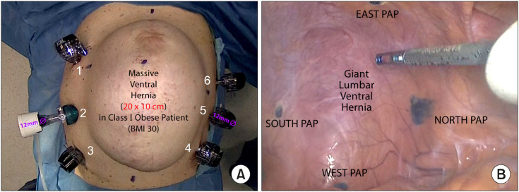 The Impact of the "Slim-Mesh" Technique on Operation Time and Short/Midterm Outcomes in 67 Overweight, Obese and Superobese Patients from a 10-year Follow-up Study.