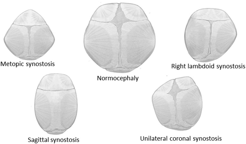 Stress and strain propagation on infant skull from impact loads during falls: a finite element analysis.