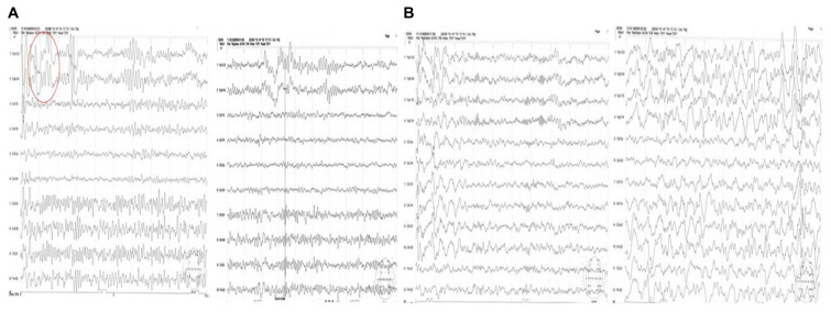 Chromosome 15q BP4-BP5 Deletion in a Girl with Nocturnal Frontal Lobe Epilepsy, Migraine, Circumscribed Hypertrichosis, and Language Impairment.