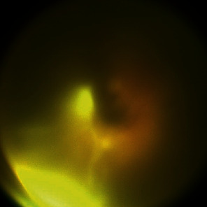 Endophthalmitis in Retinopathy of Prematurity after Intravitreal Aflibercept Injection.