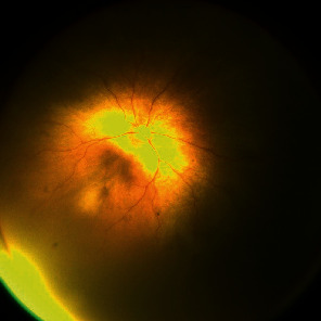 Endophthalmitis in Retinopathy of Prematurity after Intravitreal Aflibercept Injection.