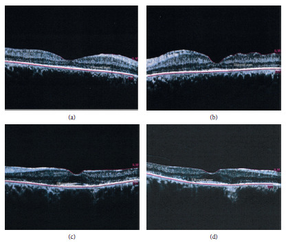 Multimodal Imaging Characteristics of ADRP in a Family with p.Thr58Arg Substituted RHO Mutation.