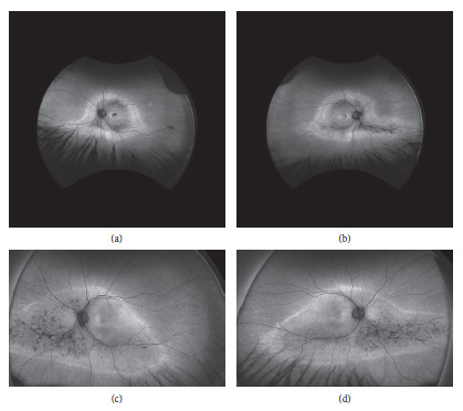 Multimodal Imaging Characteristics of ADRP in a Family with p.Thr58Arg Substituted RHO Mutation.