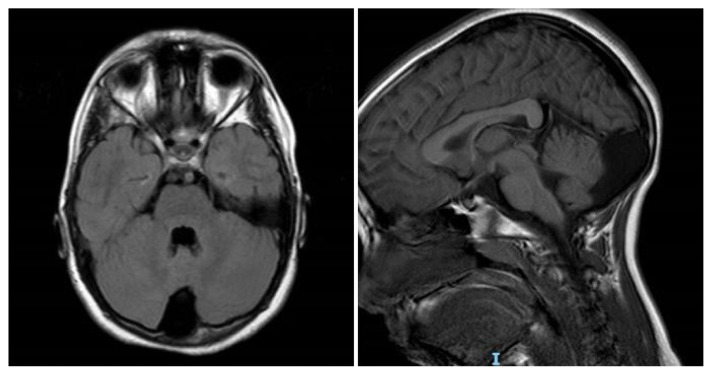 Chromosome 15q BP4-BP5 Deletion in a Girl with Nocturnal Frontal Lobe Epilepsy, Migraine, Circumscribed Hypertrichosis, and Language Impairment.