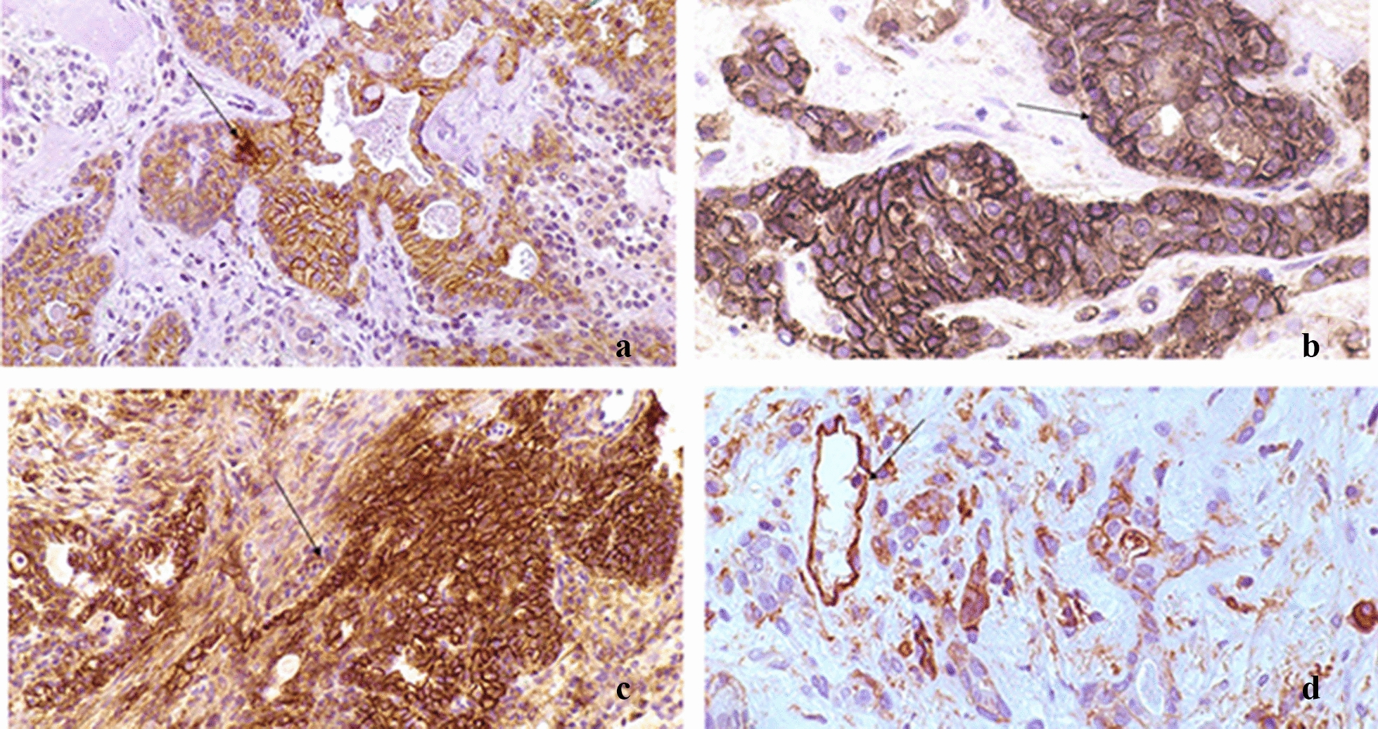 Cell adhesion molecules' altered profile in benign and malignant salivary gland tumors. The paradigm of beta4-integrin, desmoglein-2, ICAM-1 and CD44s.