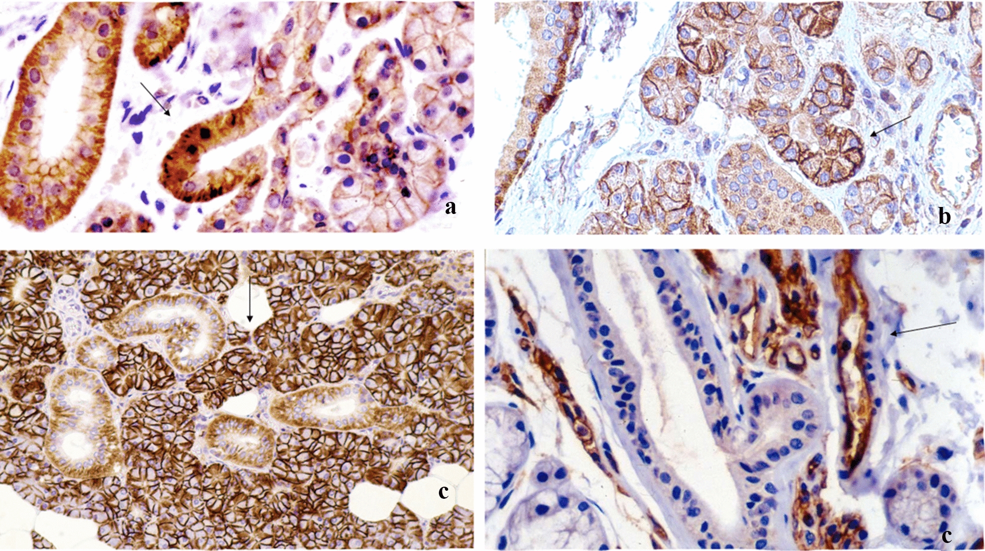 Cell adhesion molecules' altered profile in benign and malignant salivary gland tumors. The paradigm of beta4-integrin, desmoglein-2, ICAM-1 and CD44s.