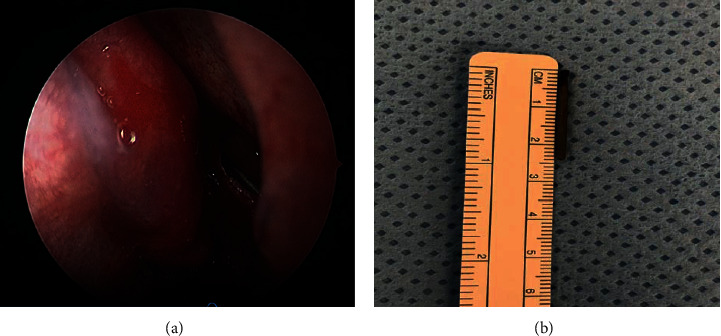 Endoscopic Removal of an Uncommon Iatrogenic Foreign Body from the Maxillary Sinus: A Dental Burr.