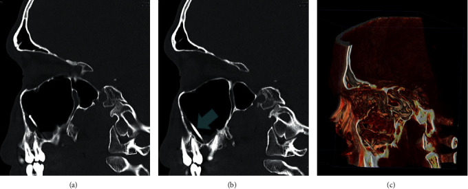 Endoscopic Removal of an Uncommon Iatrogenic Foreign Body from the Maxillary Sinus: A Dental Burr.