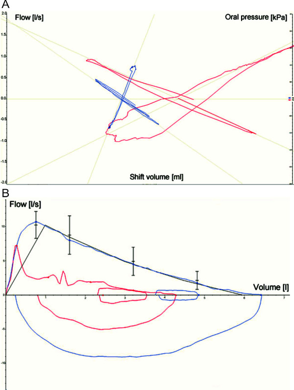 Severe bronchial reaction to provocation with fish and crustaceans.